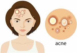 chỉ định của thuốc AC-notren