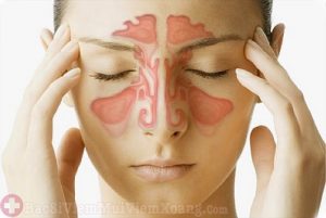 Nasalis - Điều trị viêm xoang mũi mãn tính
